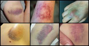 Types of bruises